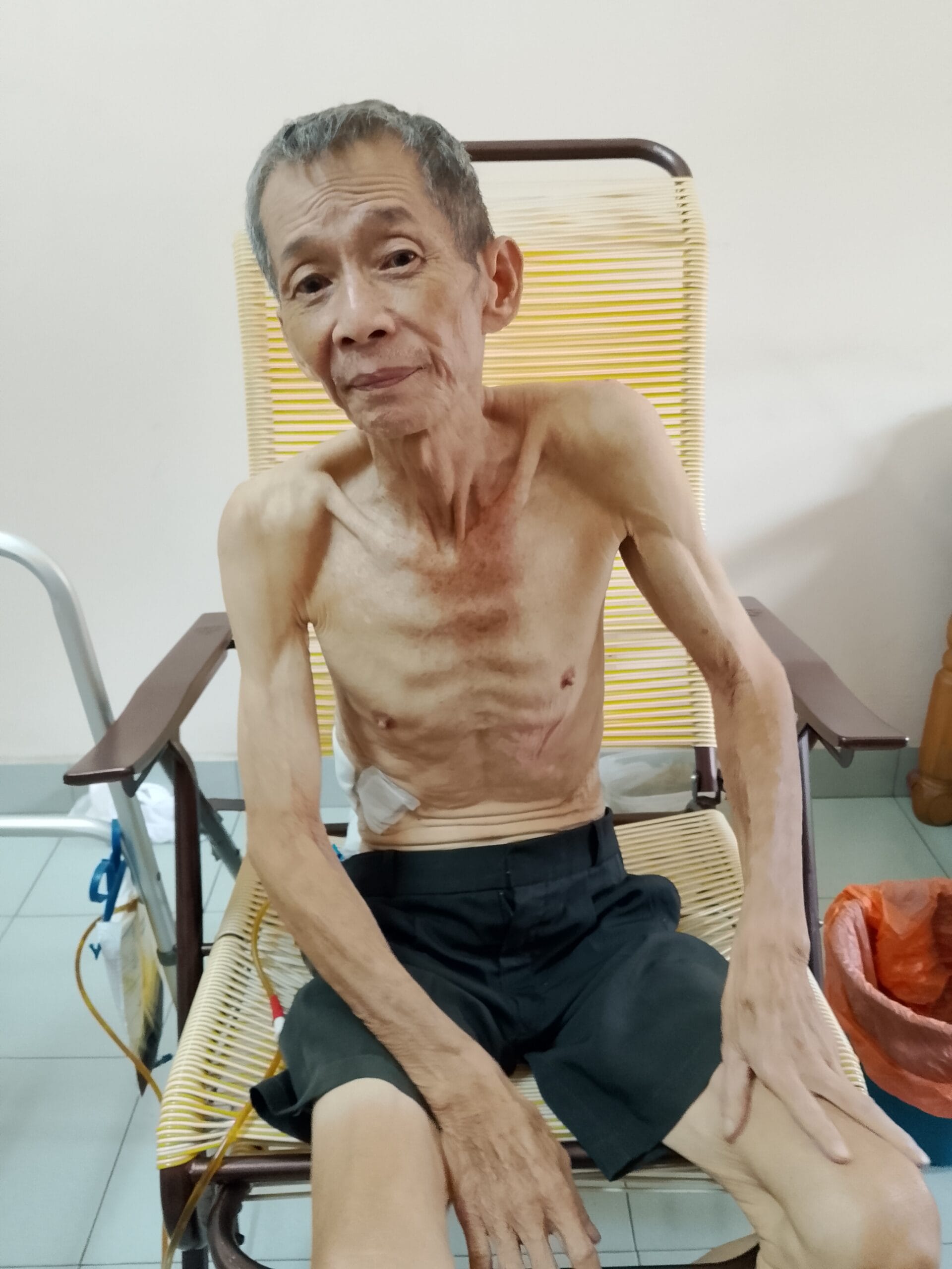 Read more about the article A 70-year-old man diagnosed with pancreatic cancer urgently needs surgery to save his life