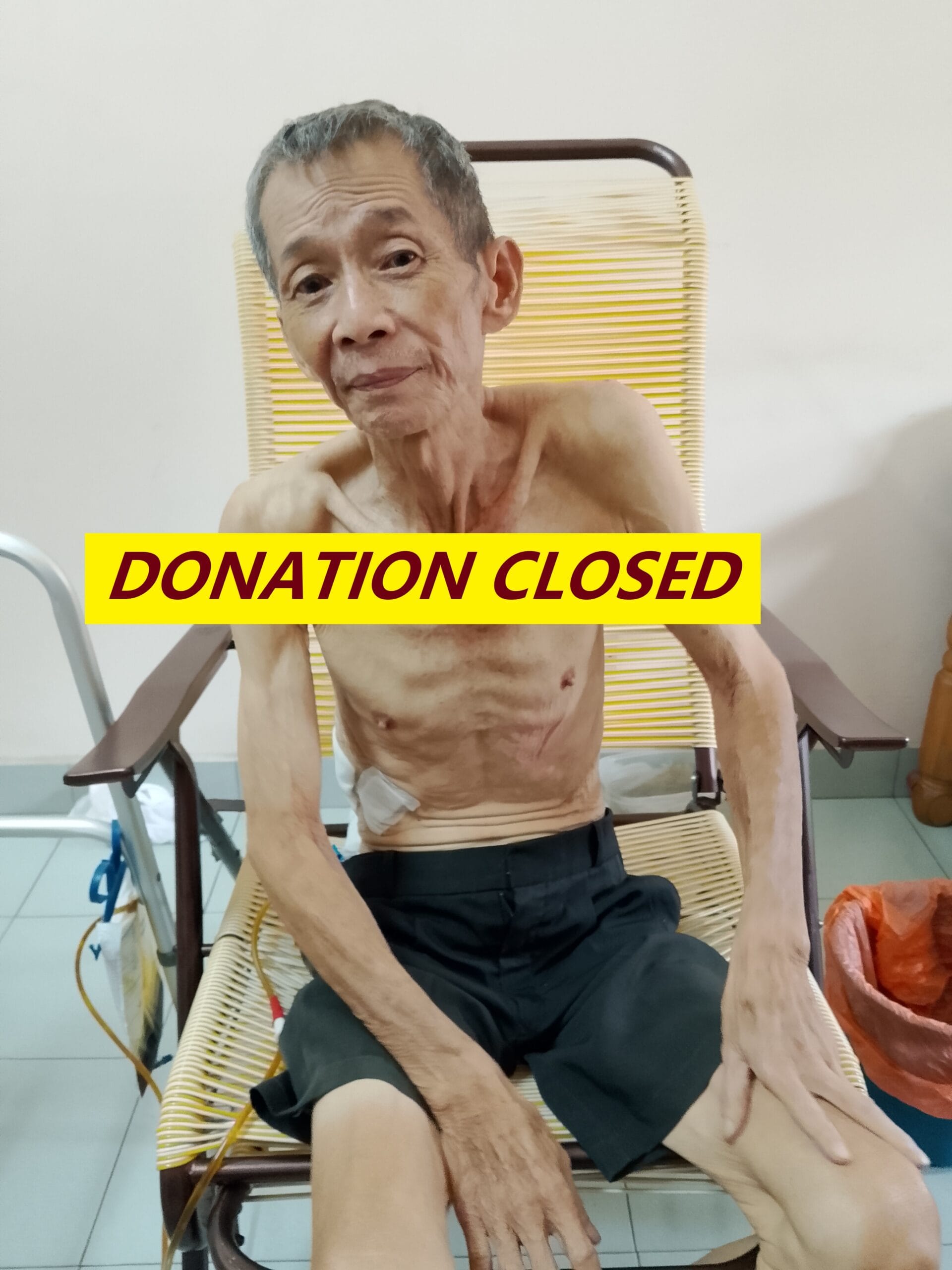 Read more about the article A 70-year-old man diagnosed with pancreatic cancer urgently needs surgery to save his life